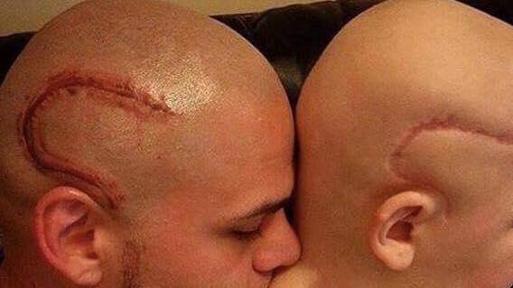 Gabriel Bambino Tumore Cervello Cicatrice