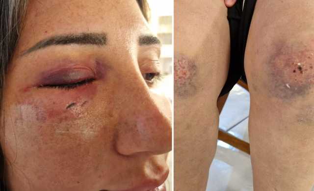 Picchiata Dall Ex Compagno