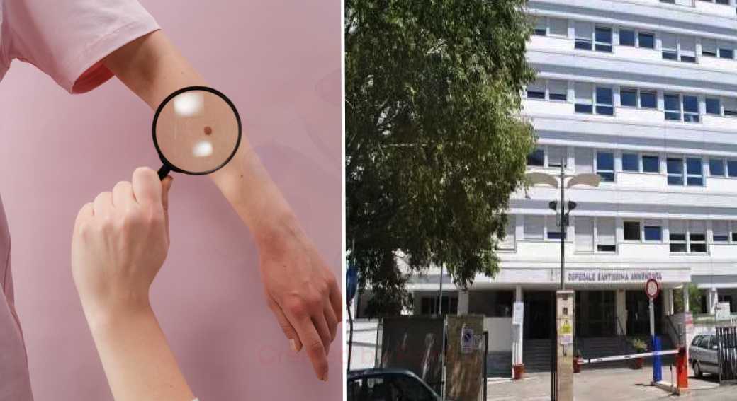 AOU-SASSARI-MELANOMA