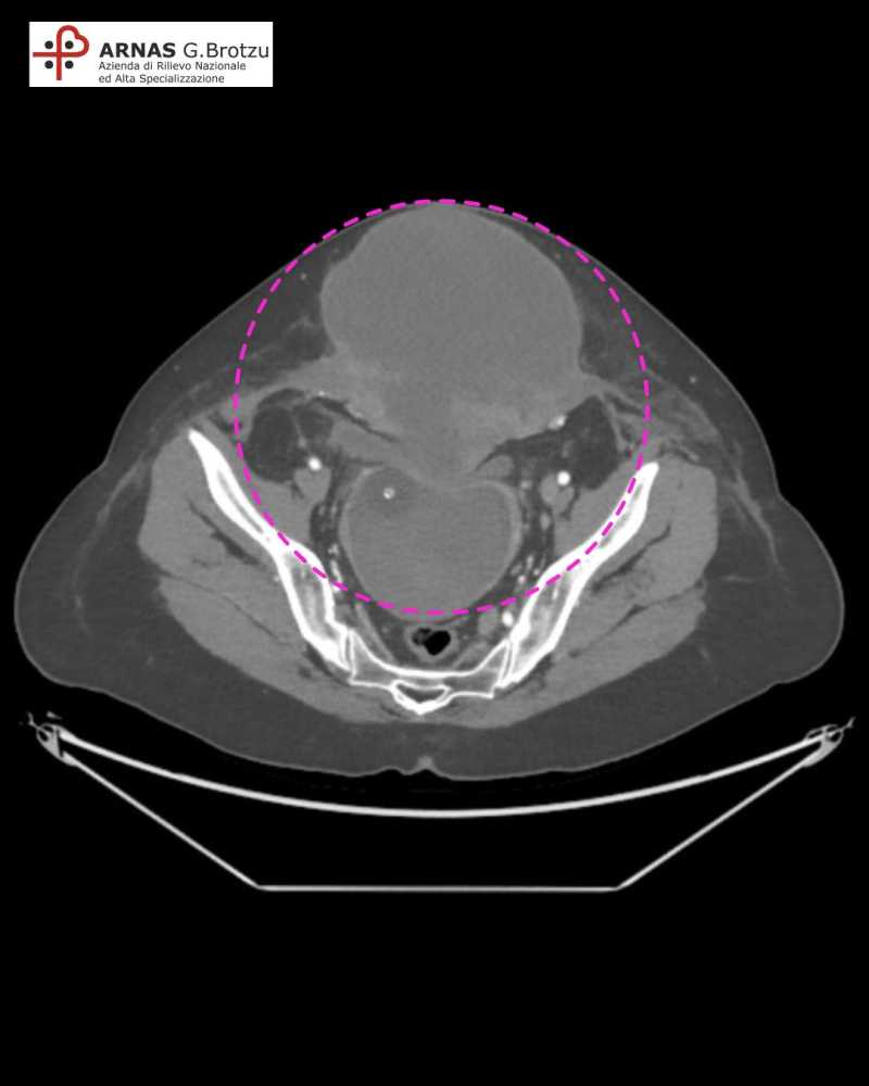 tumore-asportato-brotzu